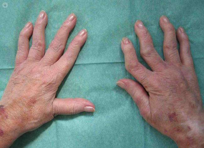 Artritis reumatoide dentro de las enfermedades más comunes en mujeres
