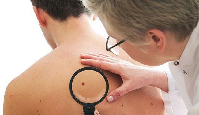 Más de 9 mil casos de melanoma fueron tratados durante el 2019